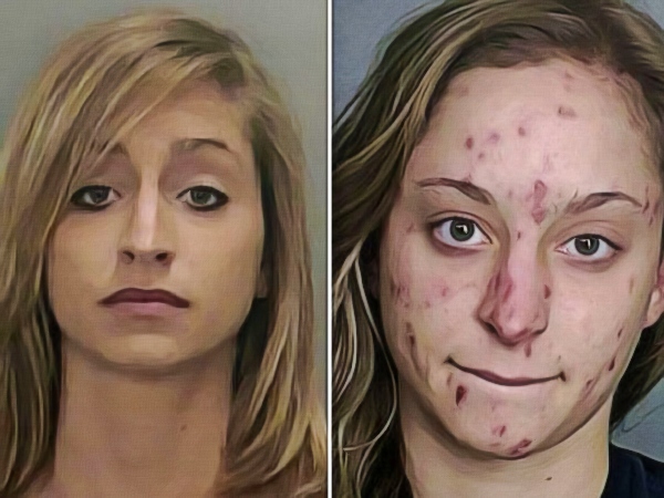 Meth sores on face